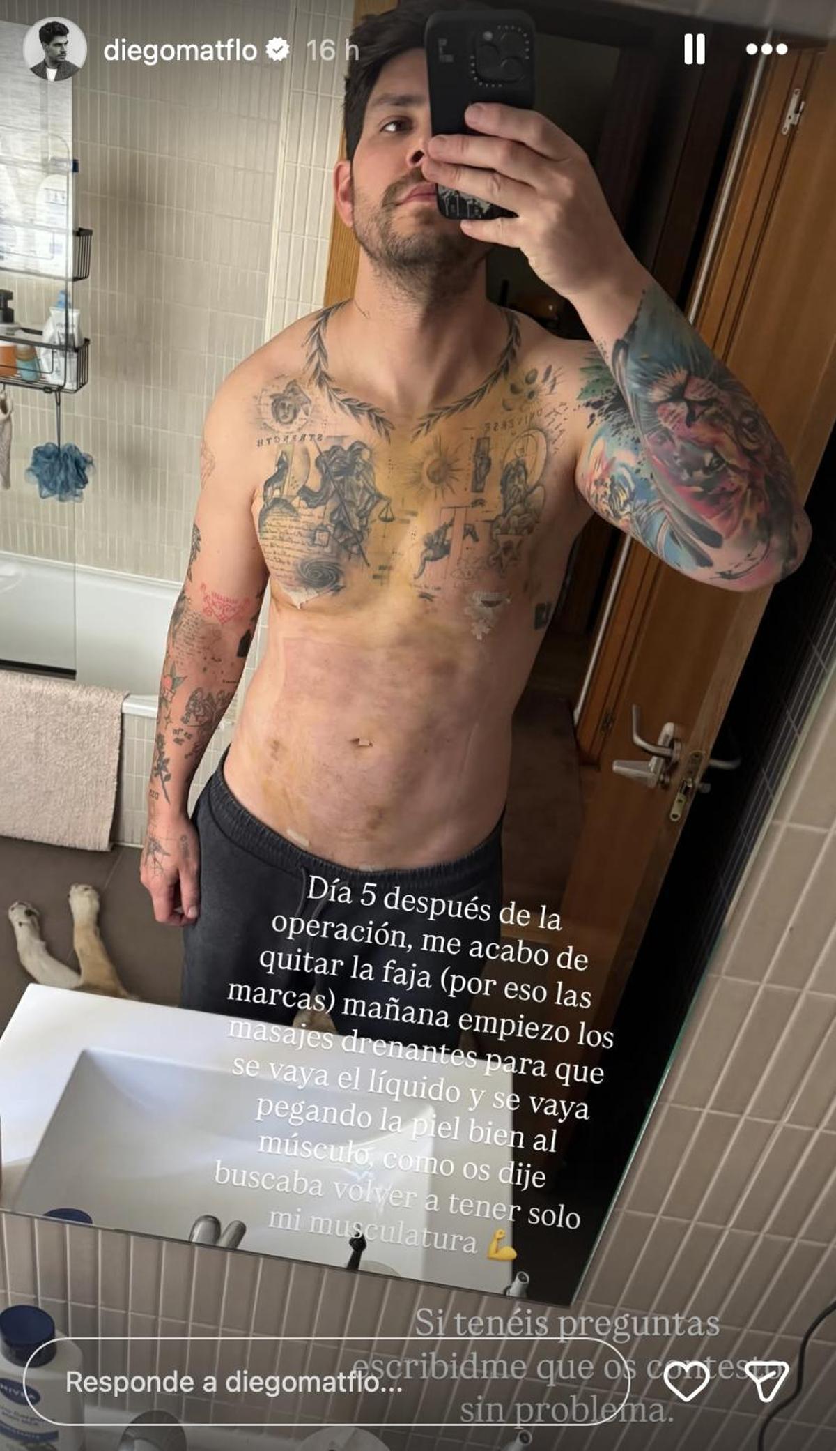 Así está Diego Matamoros cinco días después de la mastectomía