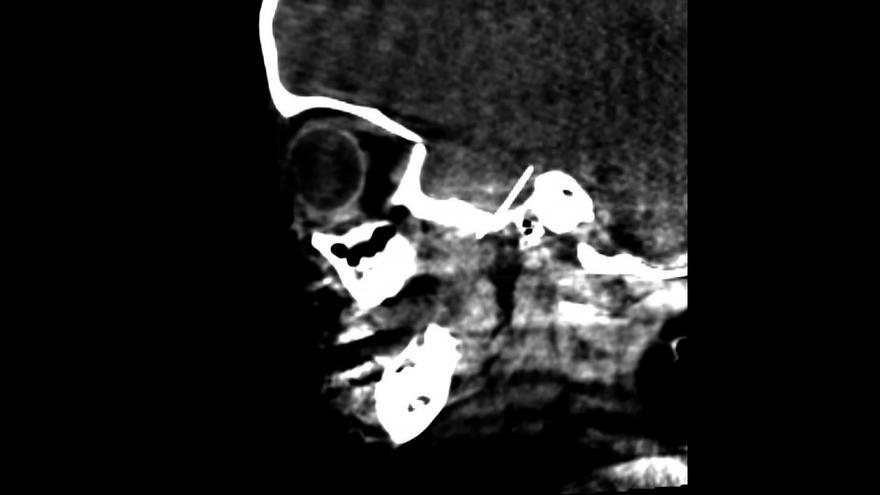 Extraen una aguja de dentista del cerebro de una niña de 4 años en Barcelona