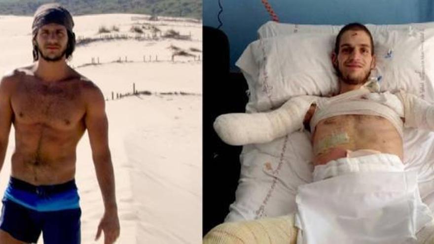 Davide, antes y después de la meningitis.