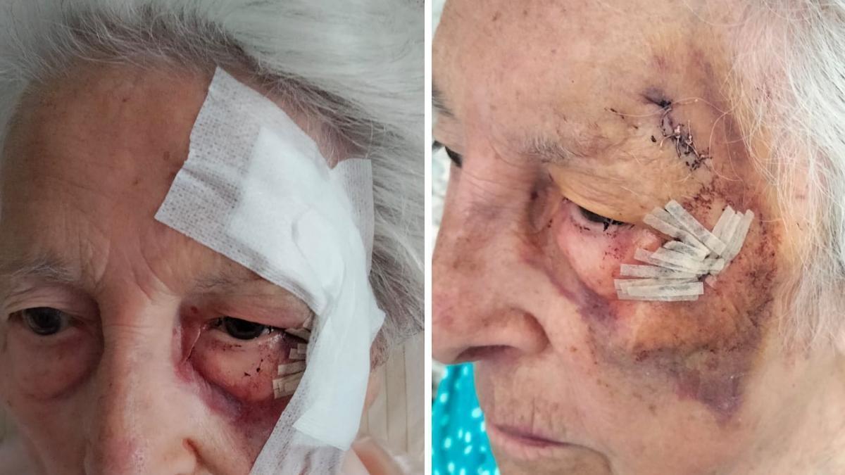 Detalle de las heridas tras la caída provocada por una baldosa del suelo en mal estado.