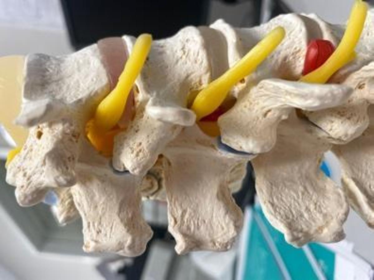 Una recreación de la columna con los nervios raquídeos y en rojo una hernia de disco en posición foraminal.