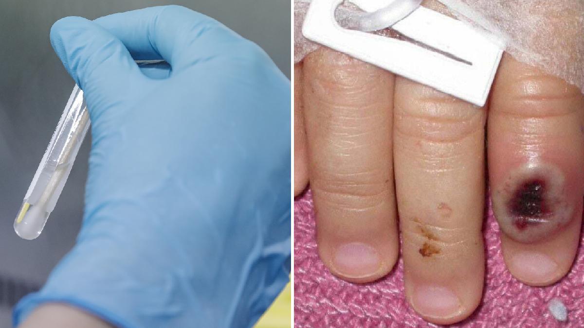 A la izquierda, una muestra del virus, y a la derecha, los síntomas de su contagio en una mano