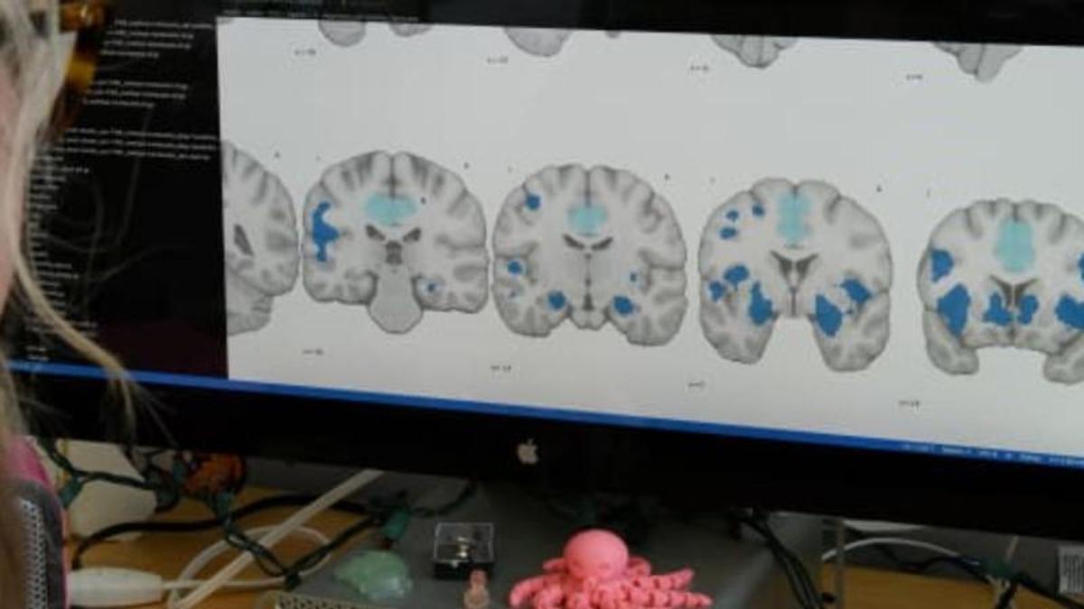 Las imágenes cerebrales resaltan áreas que se comunican con regiones que muestran alteraciones estructurales asociadas con los trastornos del sueño.