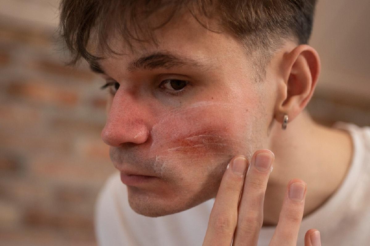 En los hombres, la rosácea puede desencadenar un engrosamiento de la nariz.