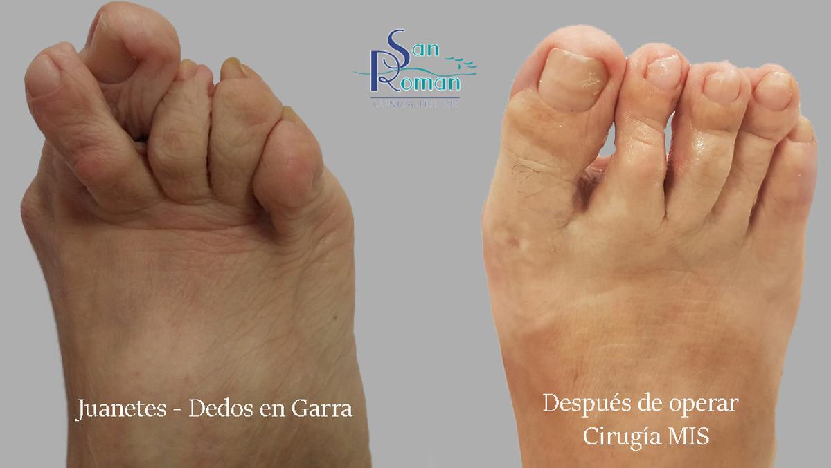 Antes y después de una cirugía de pies en Clínica San Román.
