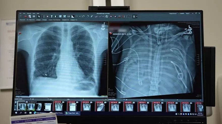 Un sistema pulmonar extracorpóreo mantiene con vida a un paciente hasta un doble trasplante de pulmón