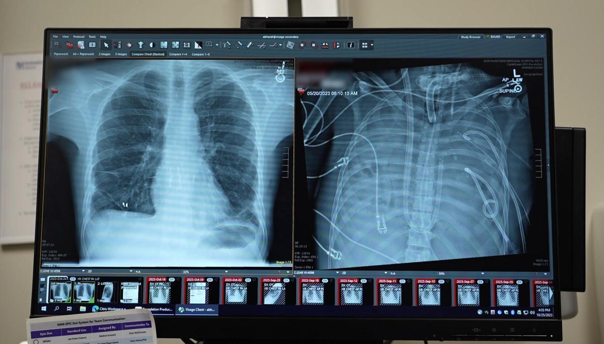 A la izquierda, imagen de los pulmones del paciente y a la derecha, muestra del órgano artificial implantado para mantenerlo con vida.