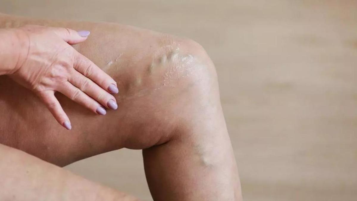 Una dona mostra les varius que pateix a les cames
