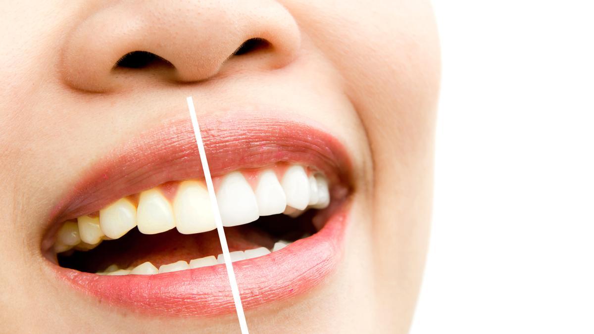 Existen numerosas causas que pueden generar tinciones dentarias