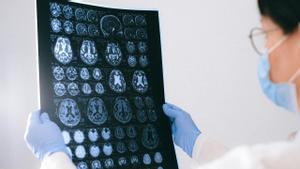 Un profesional de la salud mira las imáganes de un cerebro en un TAC.