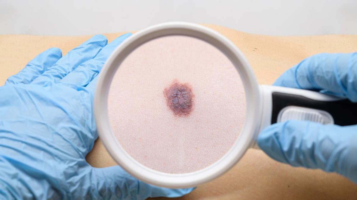 Un estudio en fase 3 demuestra resultados prometedores en la vacuna contra el melanoma, el cáncer de piel más agresivo