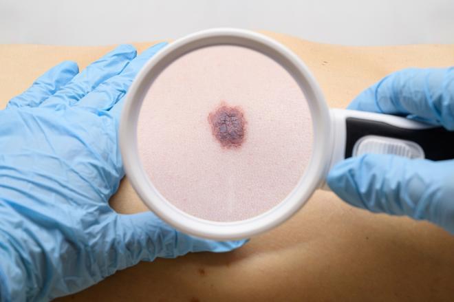 Un estudio en fase 3 demuestra resultados prometedores en la vacuna contra el melanoma, el cáncer de piel más agresivo
