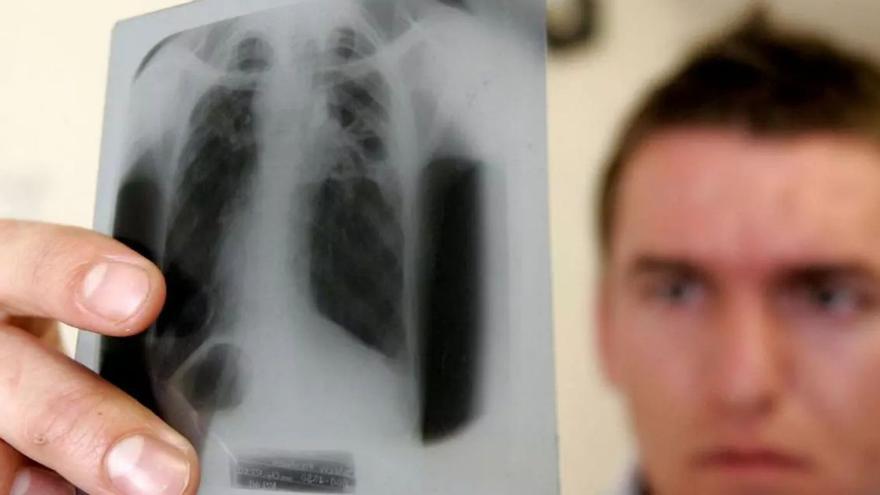 Un médico revisa una radiografía de pulmón de un paciente con tuberculosis.
| SCHALK VAN ZUYDAM / AP