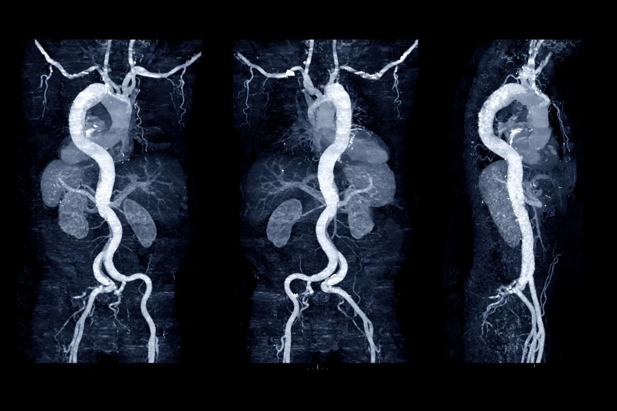 La arteritis de Takayasu provoca la inflamación de la aorta.