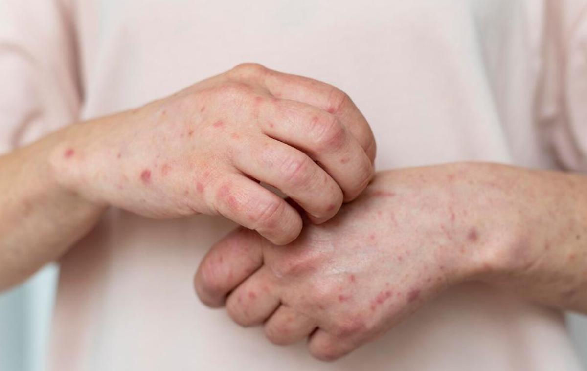 El malestar de patir dermatitis atòpica
