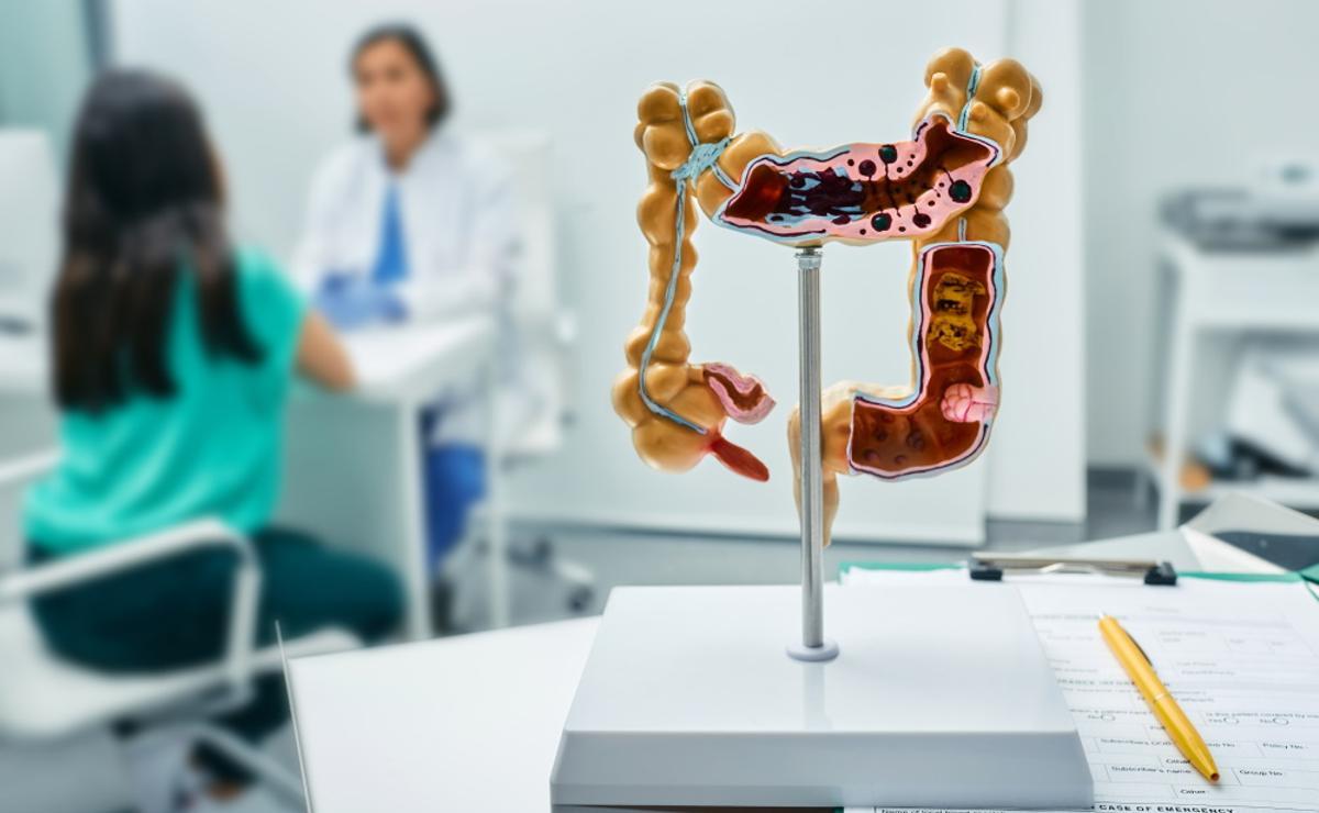 Representación del cáncer de colón.