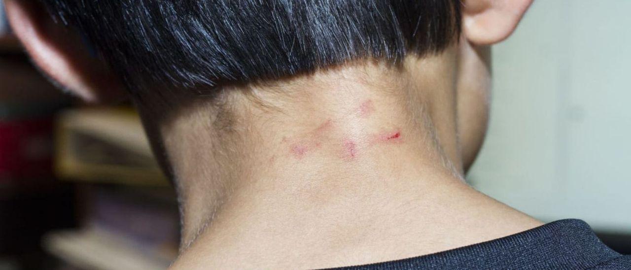 Una de las lesiones que el niño sufrió en el cuello durante una agresión denunciada por sus padres.