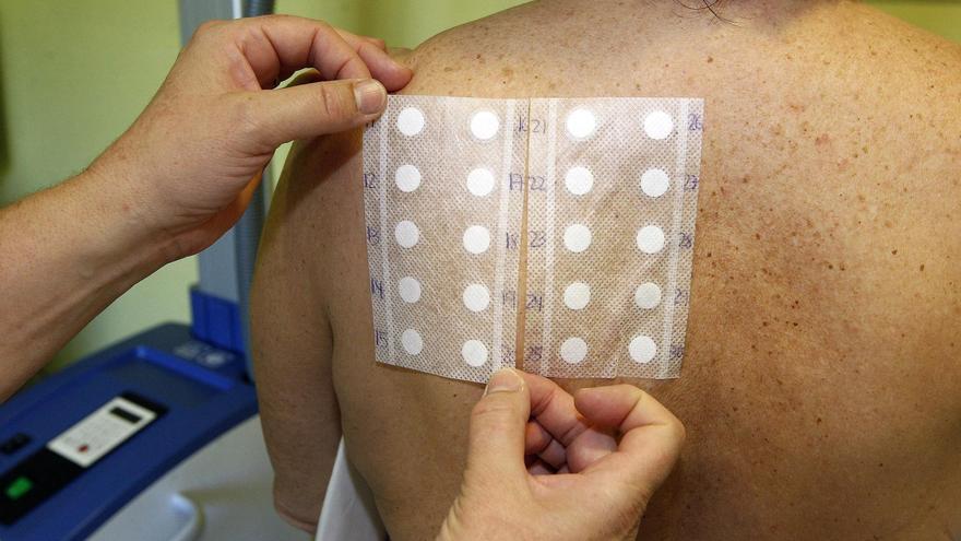 La lista de espera en Dermatología crece en un 28% en solo seis meses