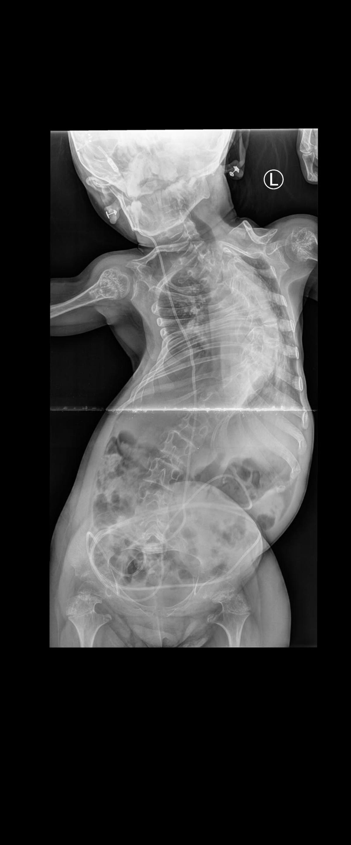 Radiografía facilitada por la familia que muestra la grave deformación de la columna que padece Sofía.