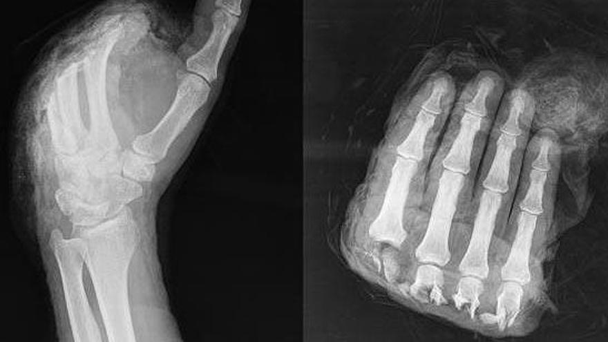 Radiografía de la mano seccionada.