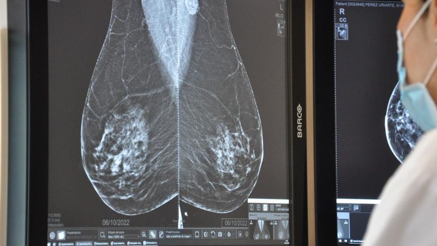 Sanidad adquiere diez nuevos mamógrafos para mejorar el diagnóstico del cáncer de mama