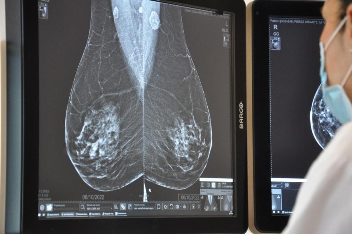 Imagen de archivo de una mamografía.