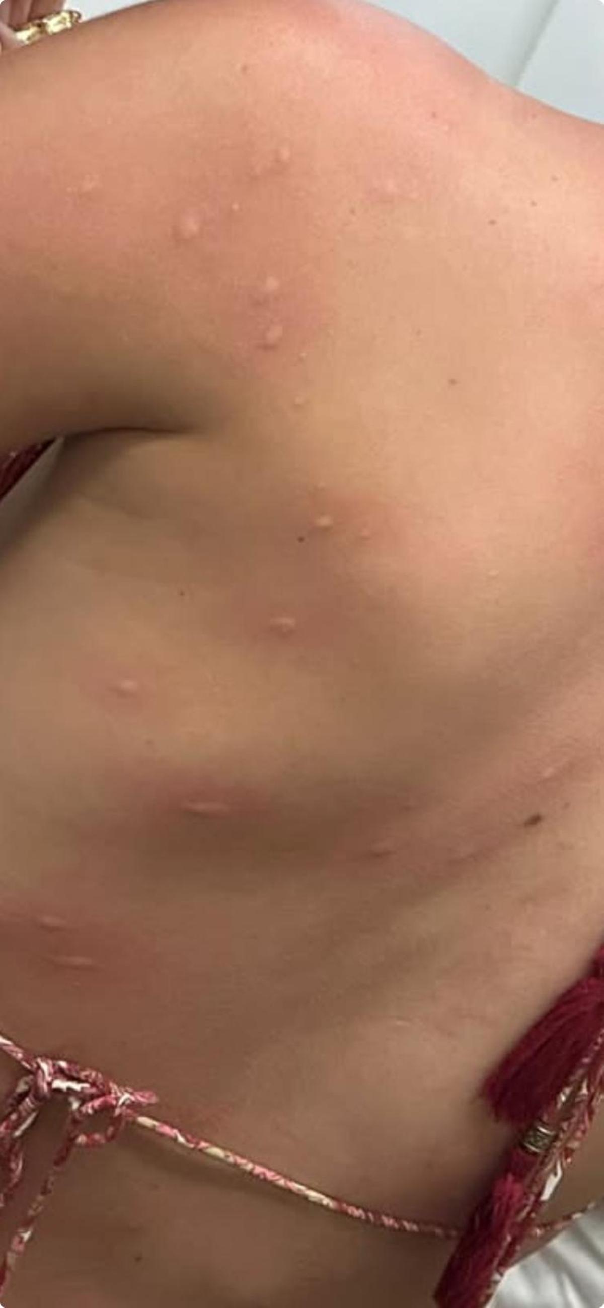 Picaduras recibidas por parte de una vecina que frecuenta las zonas afectadas.