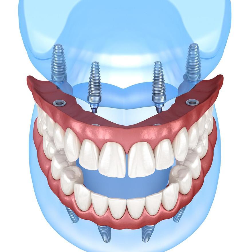 El mismo día se realizan las extracciones, se colocan los implantes y los dientes fijos.