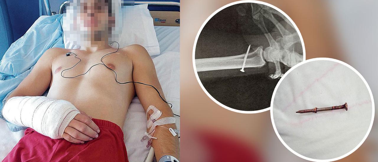 Íñigo Corbato, en una cama del Hospital de Jove. En los círculos, la radiografía en la que se aprecia la penetración del clavo en el hueso y el clavo extraído de su muñeca derecha