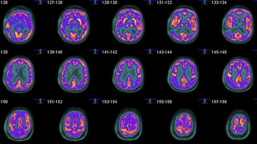 Escáner de un afectado por epilepsia.