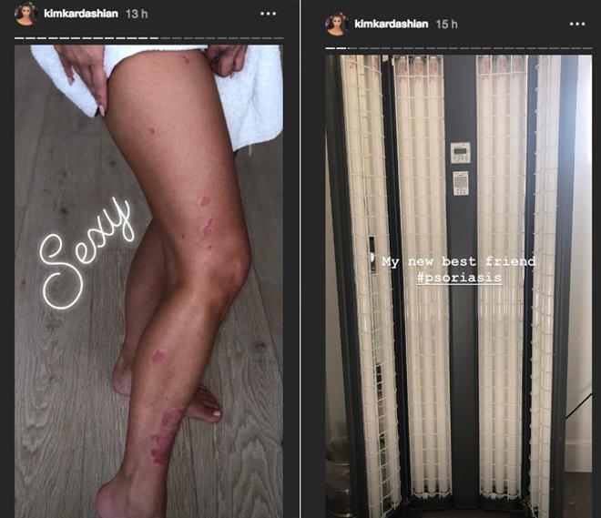 La psoriasis de Kim Kardashian y su tratamiento