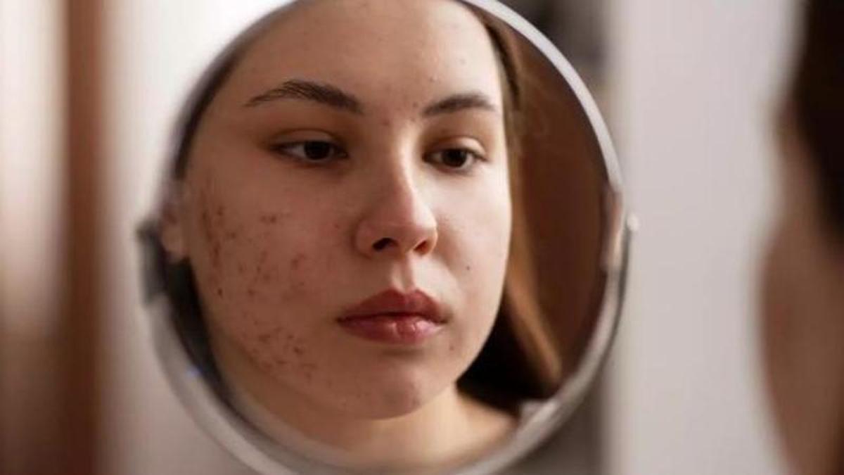 Els granets a l'edat adulta poden ser acne persistent o acne tardà