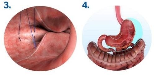 Un tipo de intervenciones realizadas por la boca y sin cicatrices, combinadas con un seguimiento médico, nutricional y psicológico.enciones realizadas por la boca y sin cicatrices, combinadas con un seguimiento médico, nutricional y psicológico.