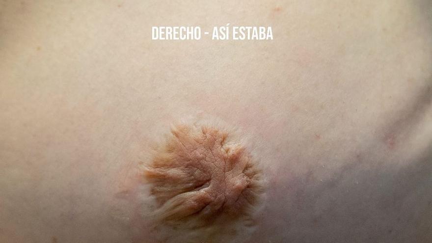 Este pezón, reconstruido en quirófano, tuvo una mala evolución. / CARBONO TATTOO