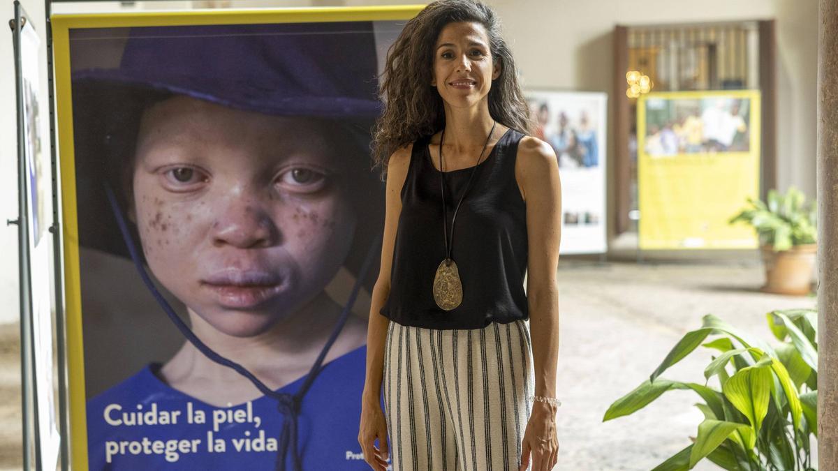 VIDEO | Mafalda Soto, presidenta y cofundadora de la ONG Beyond Suncare: "Nueve de cada diez albinos mueren antes de los 30 de cáncer de piel"