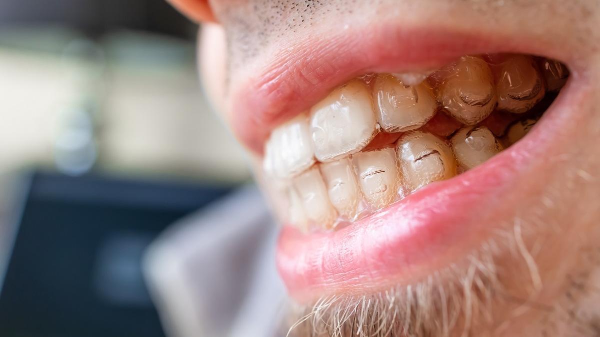 No hay que descuidar la limpieza de la ortodoncia invisible durante el verano.
