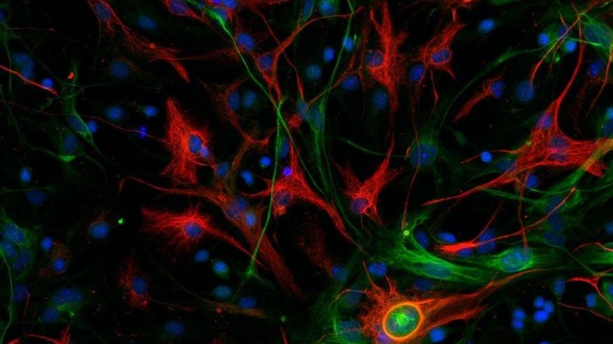 Descubren el gen que desencadena el cáncer cerebral de peor pronóstico.