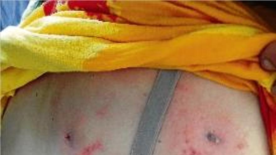 L&#039;estat de l&#039;esquena de la dona després de ser atacada per un gos llop.