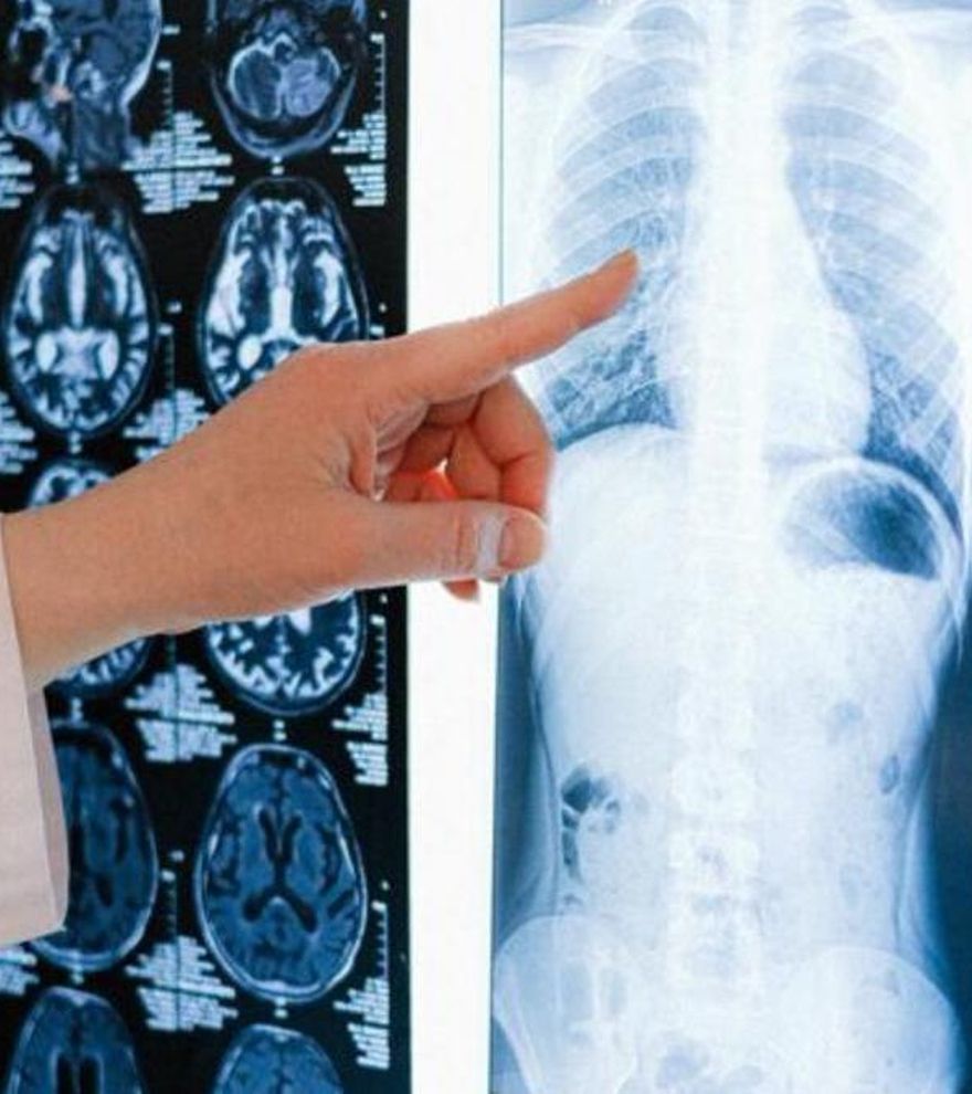 Descubren nueva vía para potenciar la inmunoterapia contra el cáncer de pulmón más agresivo