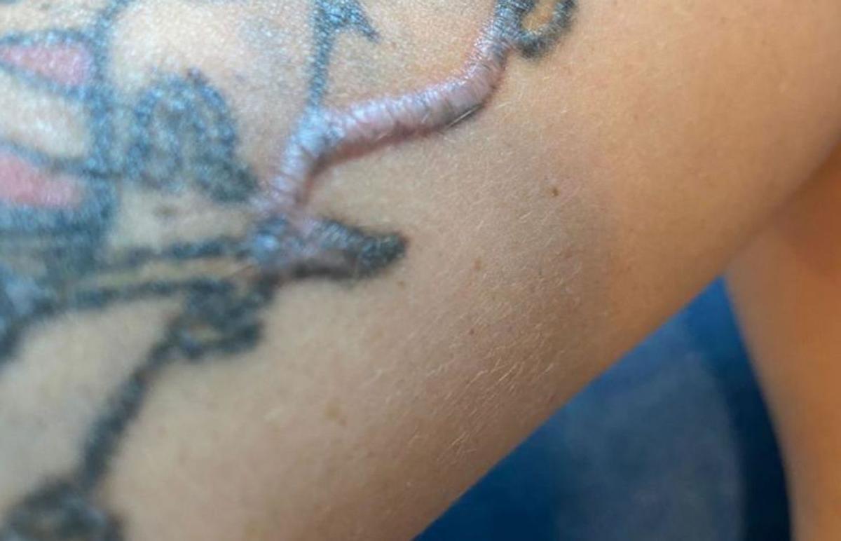 Lesión de un paciente al que le han intentado eliminiar un tatuaje sin éxito, | DI