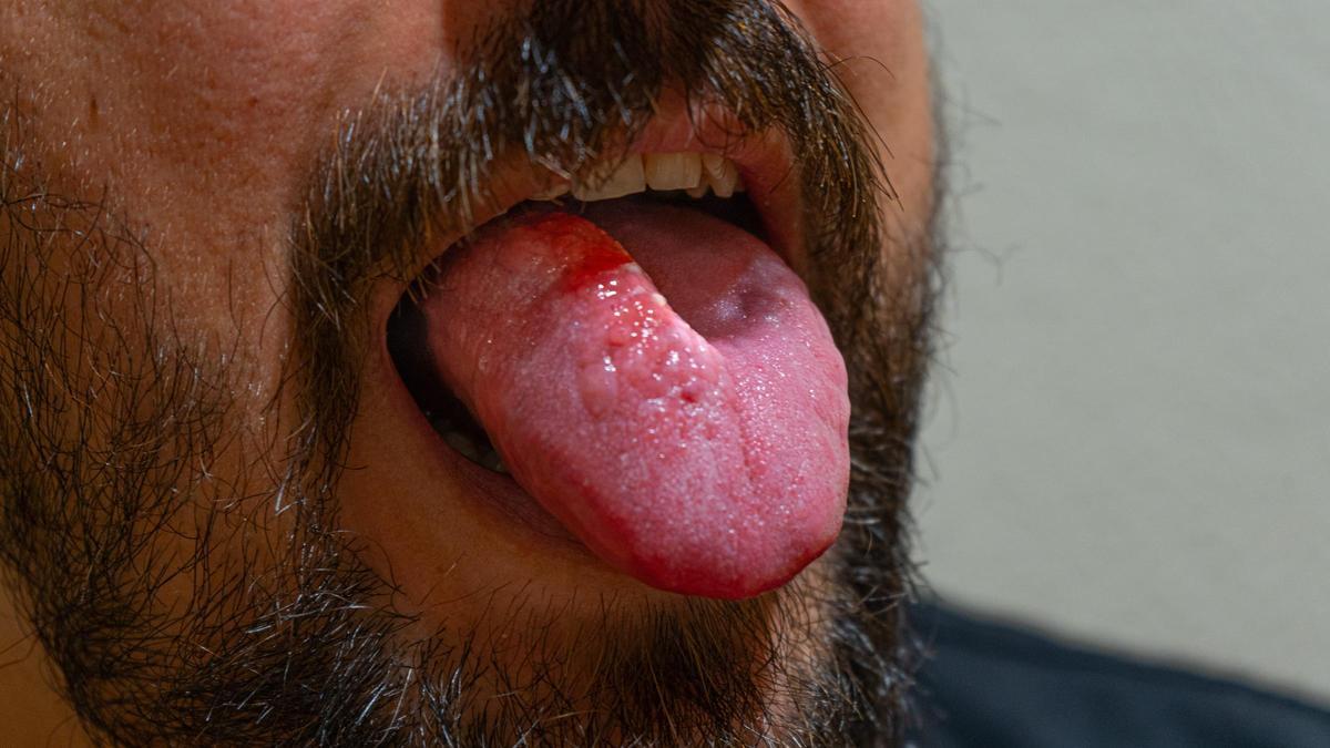 Malformación vascular en la lengua de Marc.