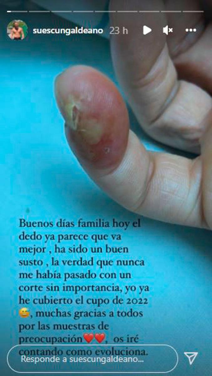 El corte en el dedo de Cristian Suescun