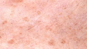 Manchas en la piel: Cómo puedes prevenir que aparezcan en verano