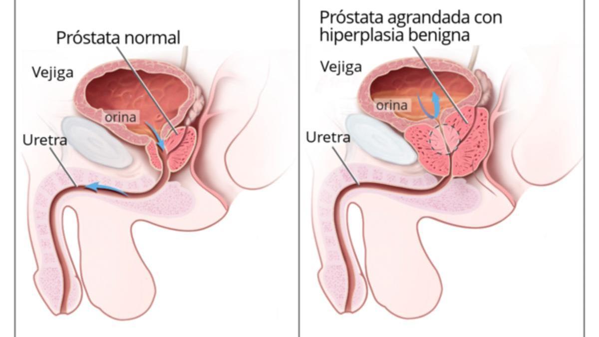 La hiperplasia benigna de próstata es un crecimiento de la próstata