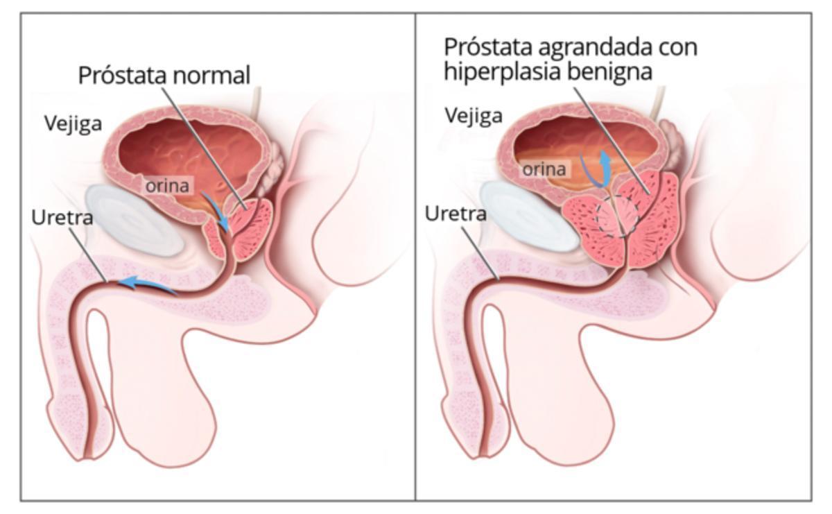 La hiperplasia benigna de próstata es un crecimiento de la próstata