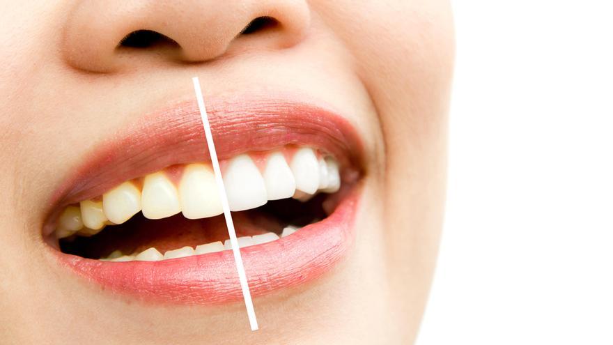 El blanqueamiento dental es el primer tratamiento con el que se puede mejorar el color de nuestros dientes