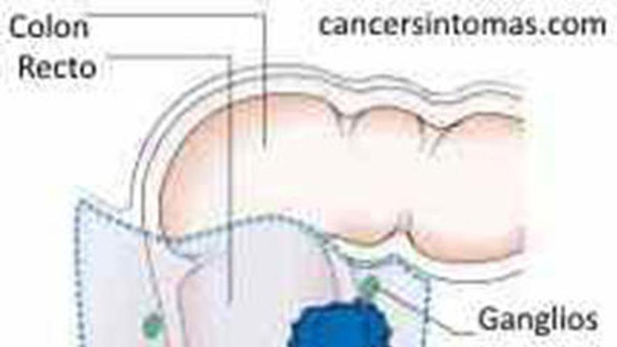 Dos operaciones de cáncer de recto en directo para unas jornadas en el Santa Lucía