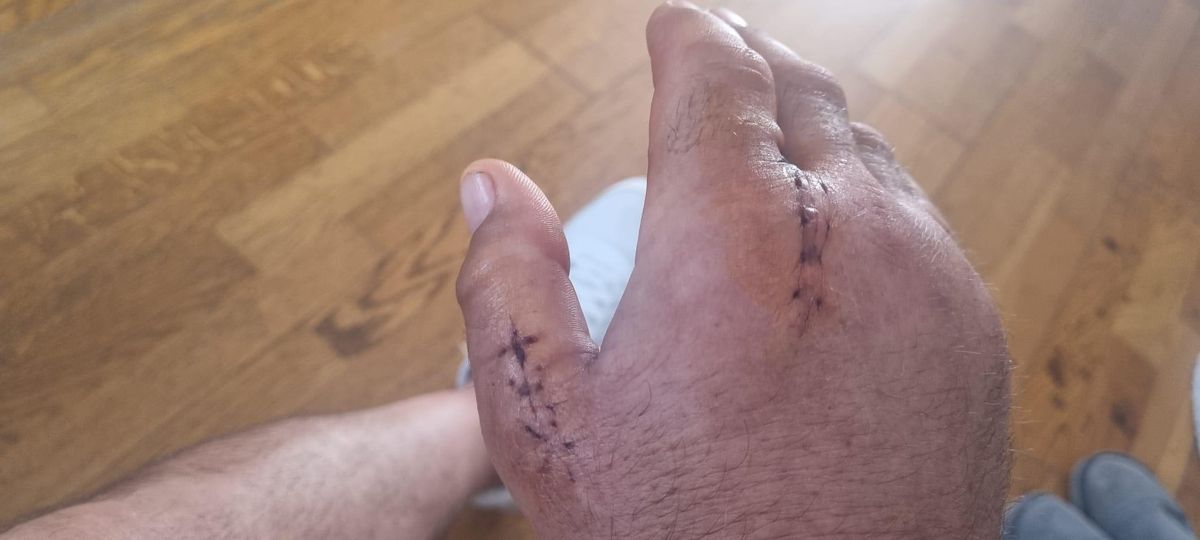 El paciente tiene dos cicatrices en la mano operada