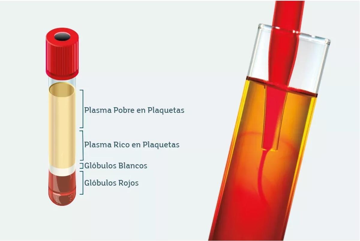 El plasma rico en plaquetas ofrece espectaculares resultados