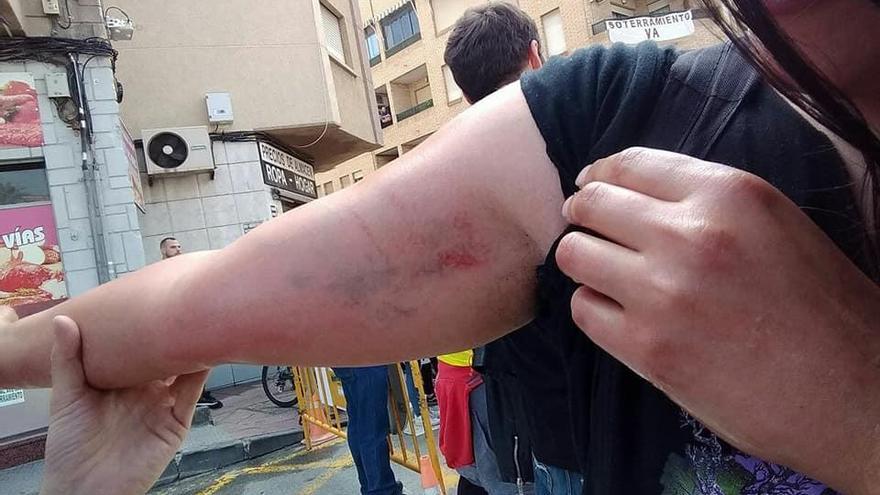 Una mujer muestra las heridas en su brazo.